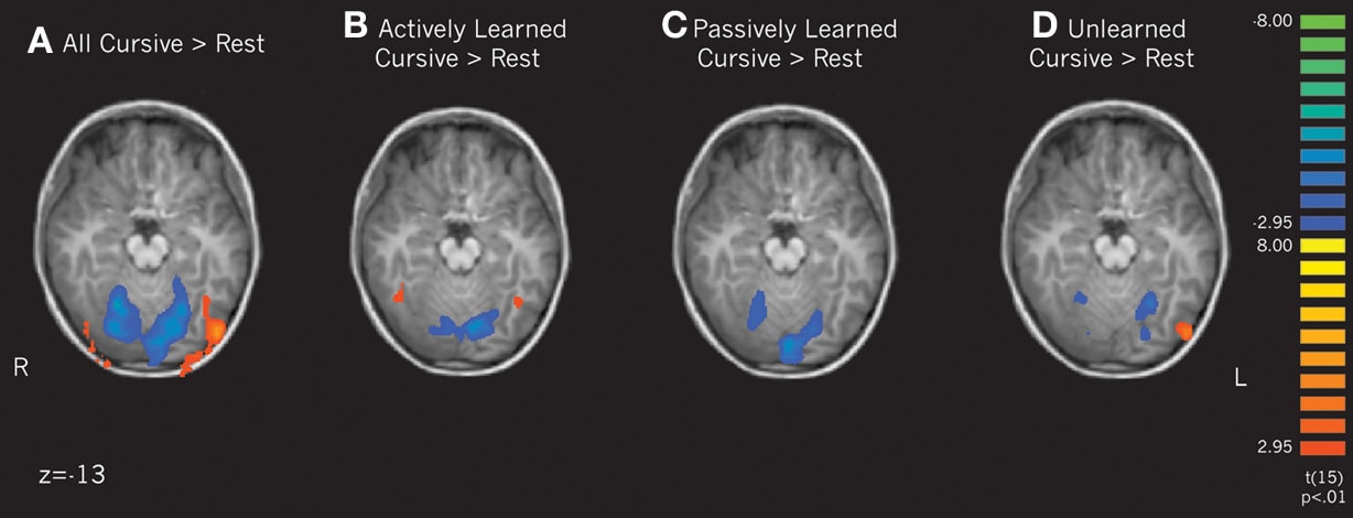 아동 fMRI: 직접 써서 배운 글자(B)와 눈으로만 배운 글자(C)를 볼 때의 뇌 활성 차이