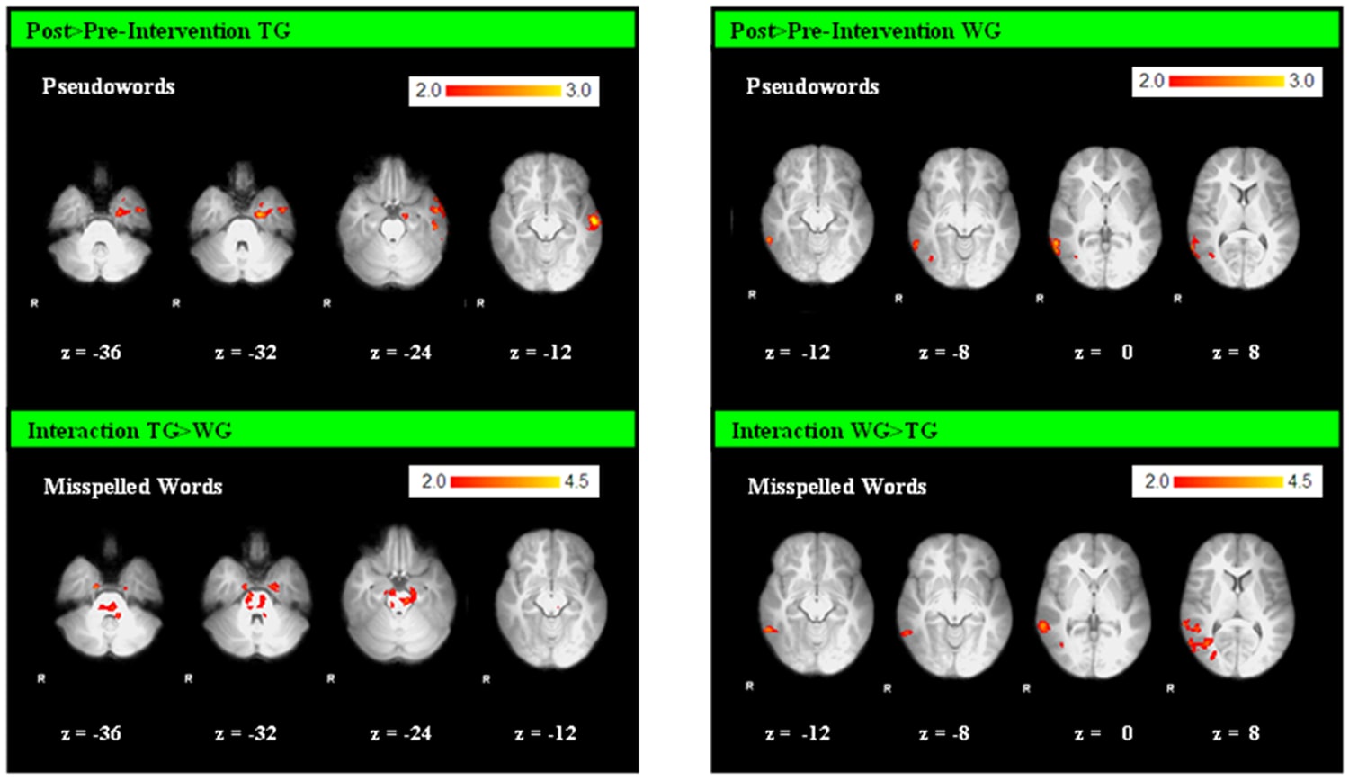아동 fMRI: 철자 훈련 전(Pre)과 후(Post)의 뇌 활성 변화 — 훈련군(TG)과 대기군(WG) 비교